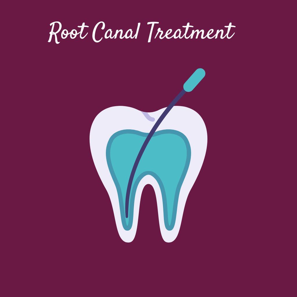 root canal treatment