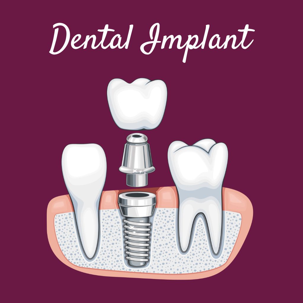 Dental Implant