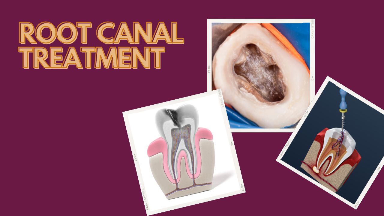 Root-Canal-Treatment Bangalore