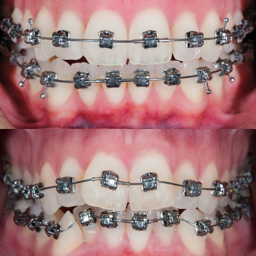 Dental Braces