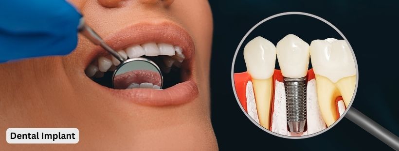 Dental Implant In Bangalore