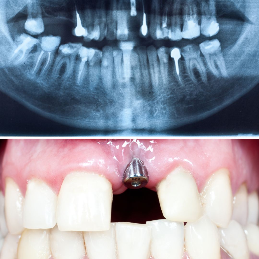 Dental Implant In Sanjaynagar Bangalore