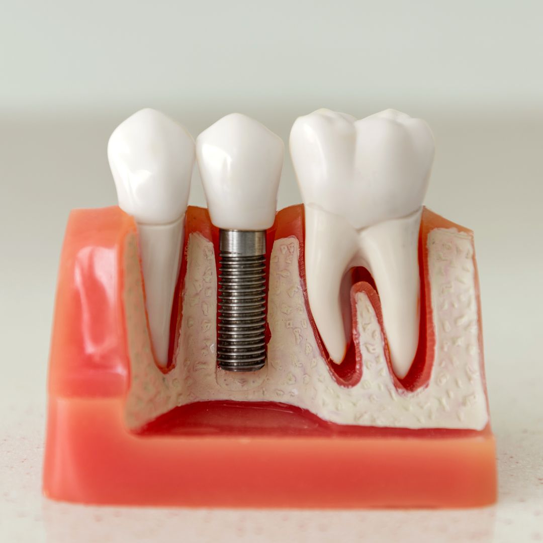 Dental Implant In Sanjaynagar Bangalore