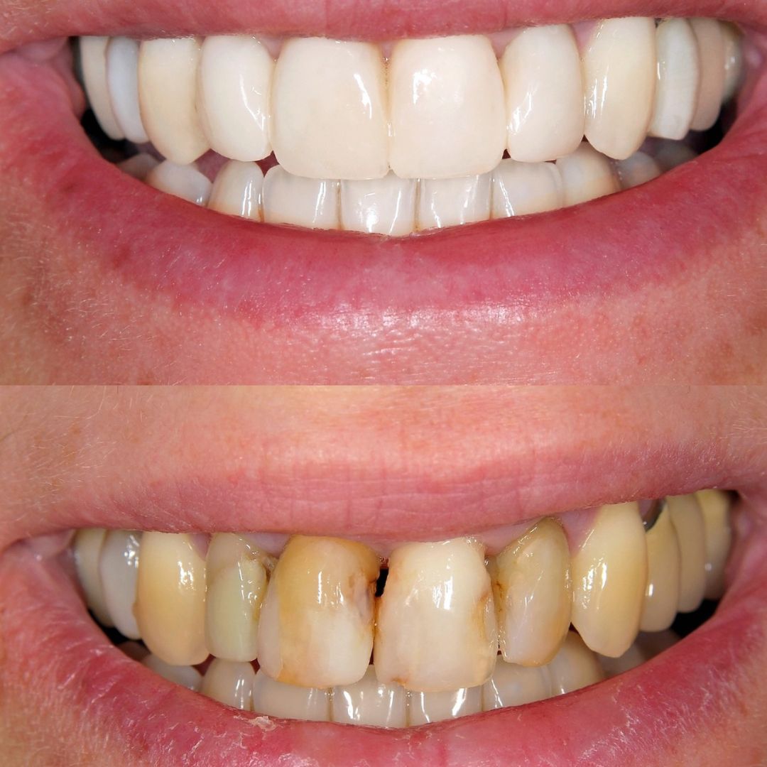 Dental Veneer In Sanjaynagar Bangalore