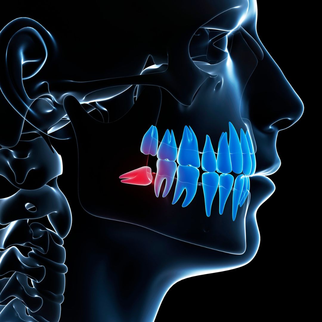 Wisdom Tooth Extraction In Sanjaynagar Bangalore