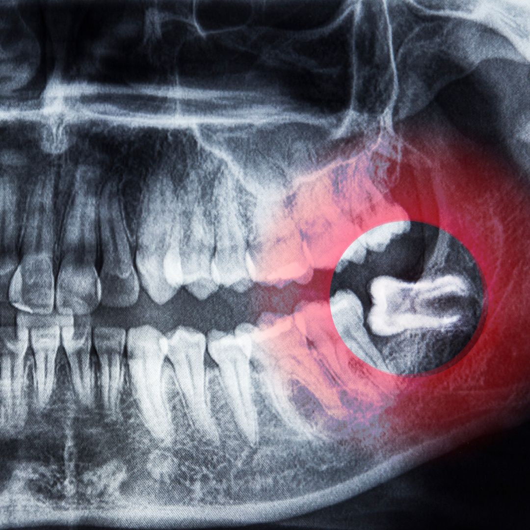 Wisdom Tooth Extraction In Sanjaynagar Bangalore