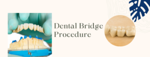 Dental Bridge - Kasthuri Dental Care Centre