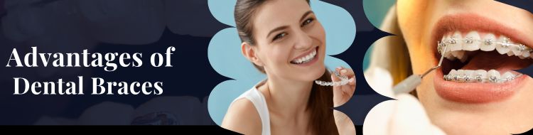 Advantages-Of-Braces