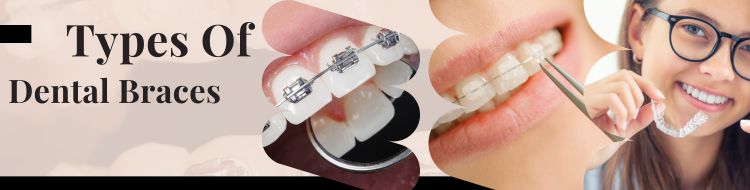 Types-Of-Dental-Braces