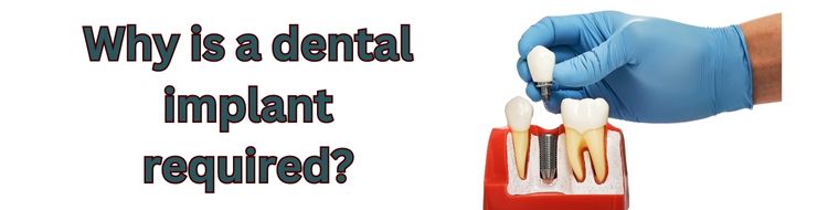 Why is a dental implant required