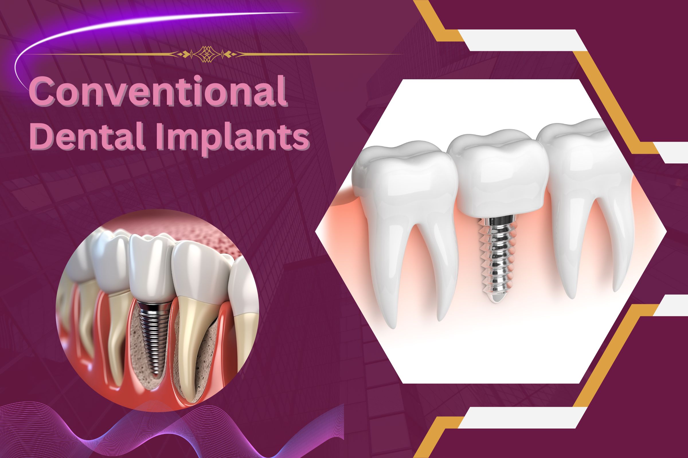 Conventional Dental Implants