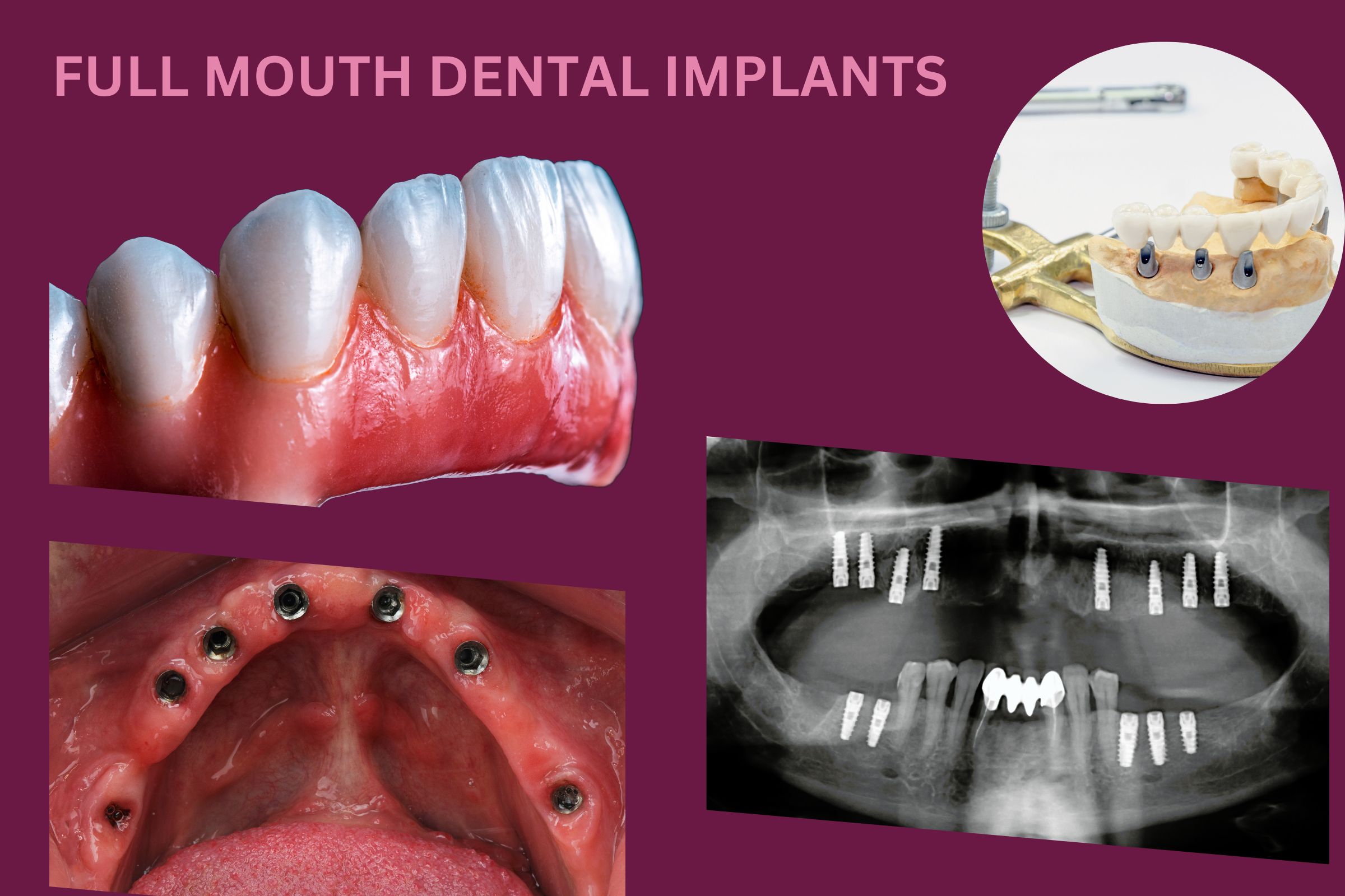 FULL MOUTH DENTAL IMPLANTS