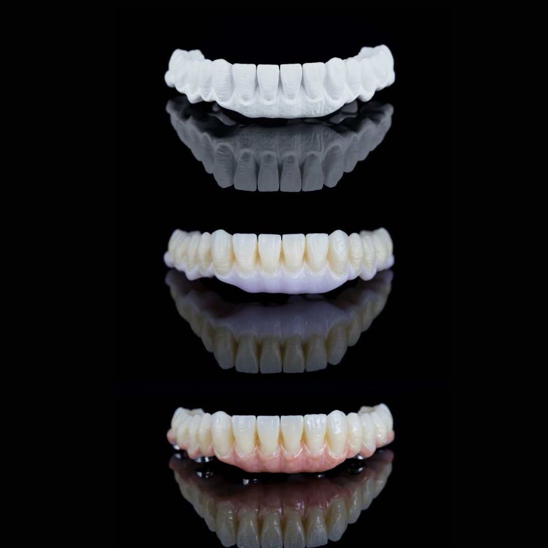 full mouth dental implants